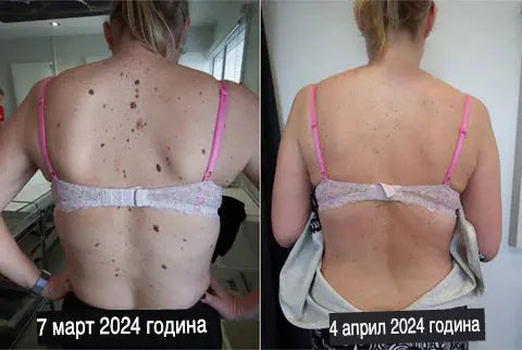 TagRecede Спреј против брадавици, папиломи и израстоци