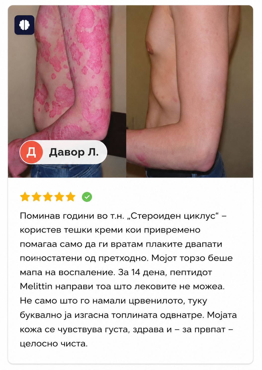 🌿 PsoriaSoothe – Крем за Нега на Кожа Склонa Кон Псоријаза, Егзема и Дерматитис