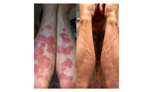 🌿 PsoriaSoothe – Крем за Нега на Кожа Склонa Кон Псоријаза, Егзема и Дерматитис