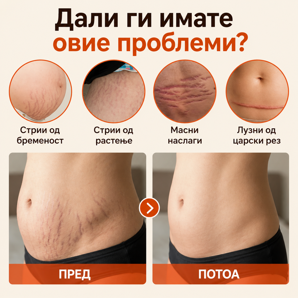 SilkStretch® Премиум Природно Масло против Стрии и Лузни