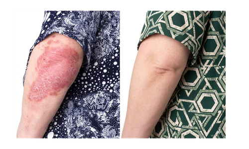 🌿 PsoriaSoothe – Крем за Нега на Кожа Склонa Кон Псоријаза, Егзема и Дерматитис