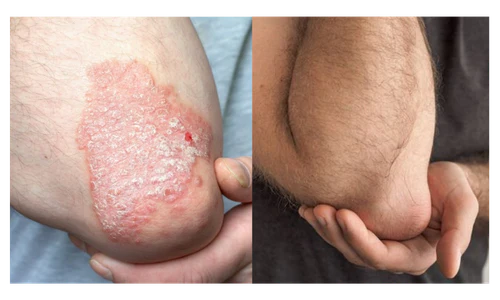 🌿 PsoriaSoothe – Крем за Нега на Кожа Склонa Кон Псоријаза, Егзема и Дерматитис