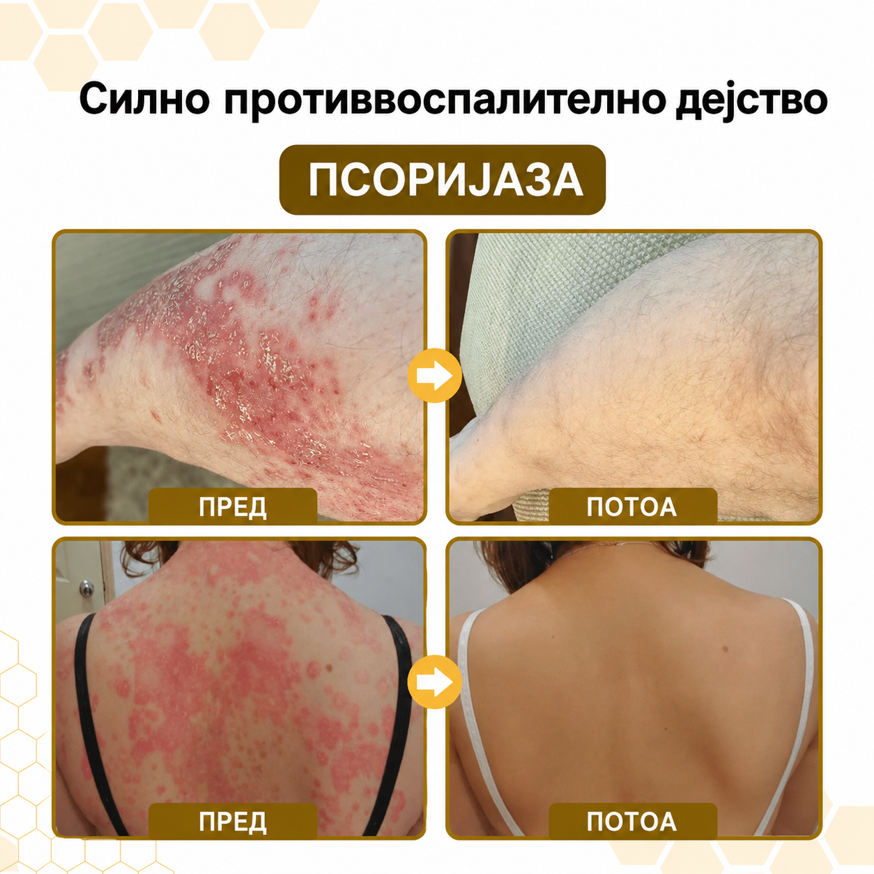 🌿 PsoriaSoothe – Крем за Нега на Кожа Склонa Кон Псоријаза, Егзема и Дерматитис