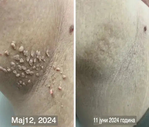 TagRecede Спреј против брадавици, папиломи и израстоци