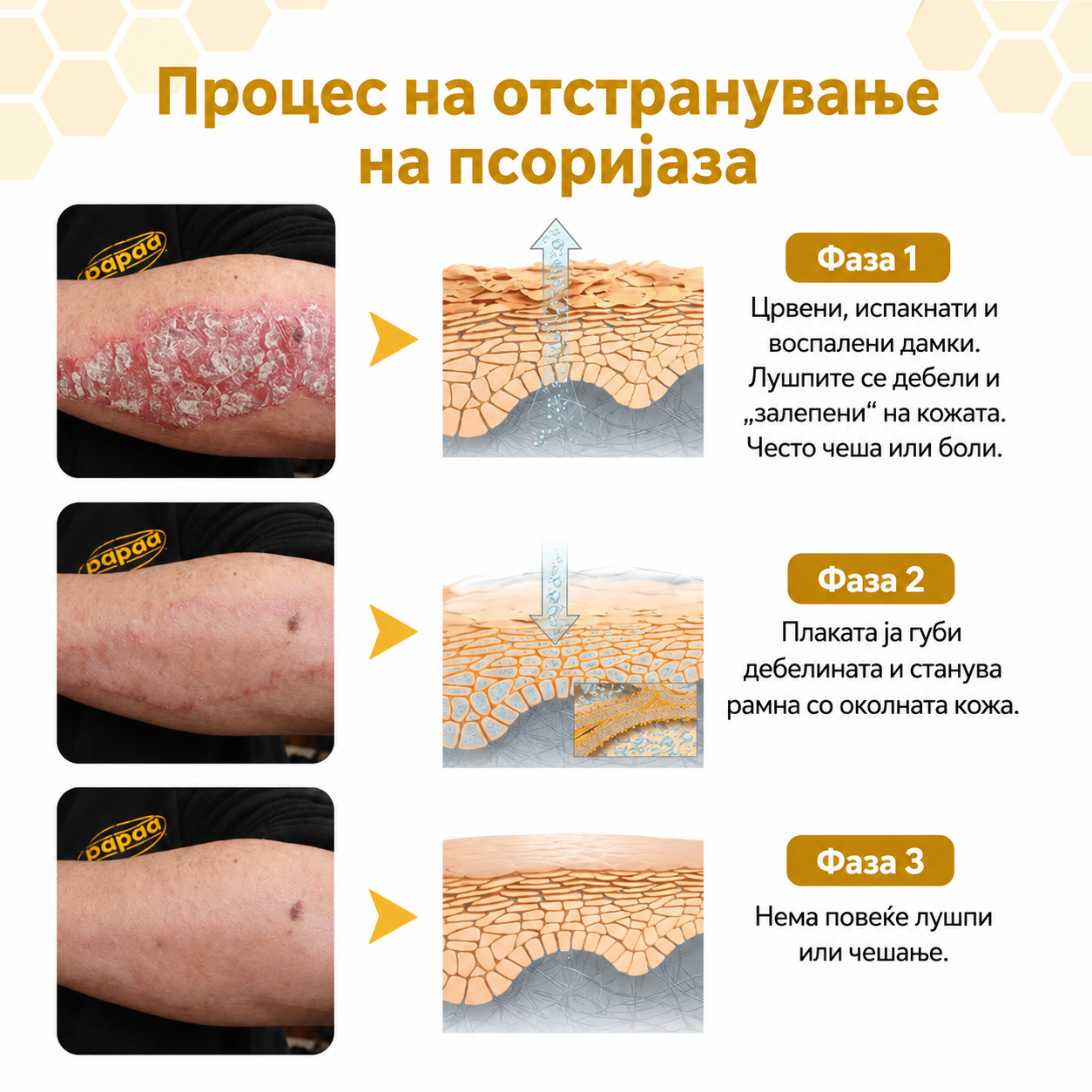 🌿 PsoriaSoothe – Крем за Нега на Кожа Склонa Кон Псоријаза, Егзема и Дерматитис