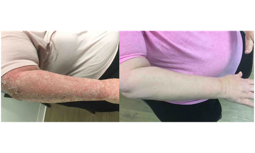 🌿 PsoriaSoothe – Крем за Нега на Кожа Склонa Кон Псоријаза, Егзема и Дерматитис