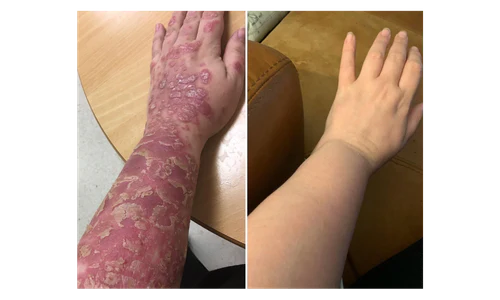 🌿 PsoriaSoothe – Крем за Нега на Кожа Склонa Кон Псоријаза, Егзема и Дерматитис