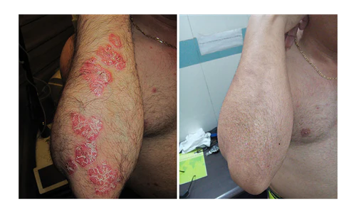🌿 PsoriaSoothe – Крем за Нега на Кожа Склонa Кон Псоријаза, Егзема и Дерматитис
