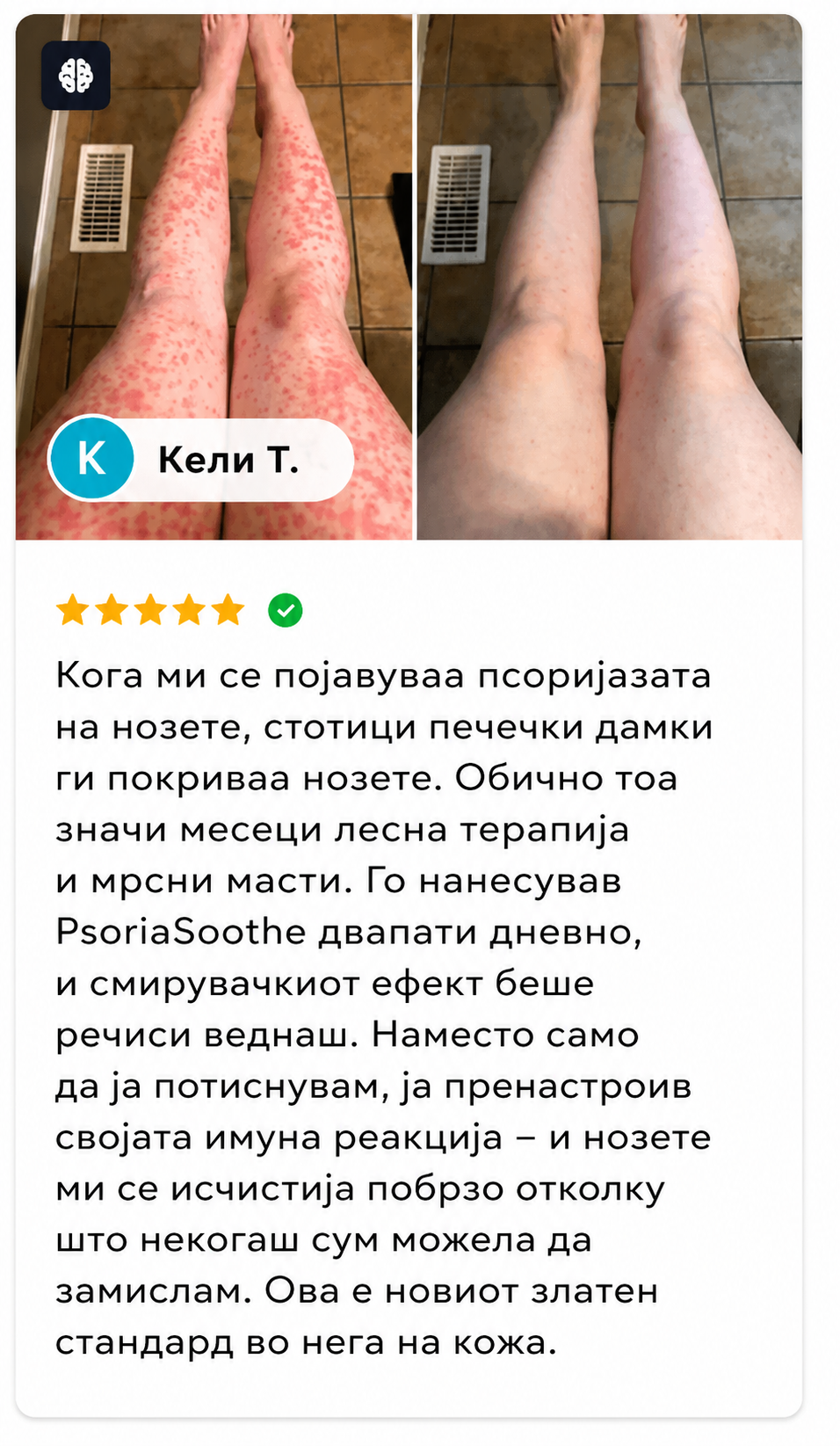 🌿 PsoriaSoothe – Крем за Нега на Кожа Склонa Кон Псоријаза, Егзема и Дерматитис