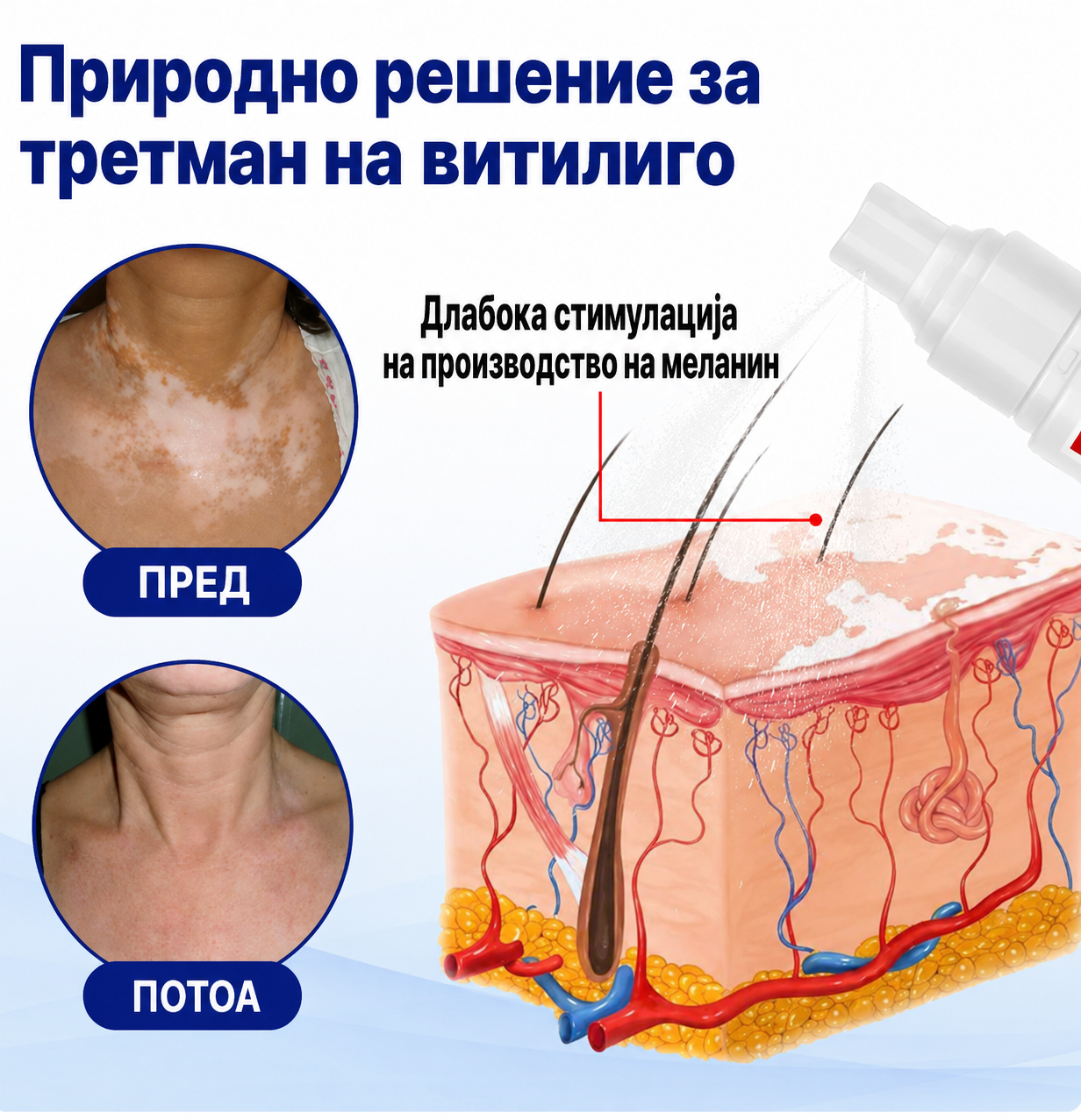 KUBOZN® Спреј за нега на кожа со витилиго Видливо подобрување за неколку недели • 100% природна формула • Без стероиди*